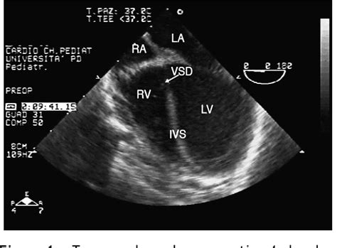 Figure From Unexpected Interventricular Septal Hematoma After