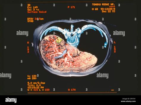 Liver Scanner Result Stock Photo Alamy