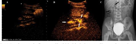 Figure 1 From Comparison Of Voiding Cystourethrography And