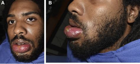 What Causes Staph Infection On Lips Lipstutorial Org