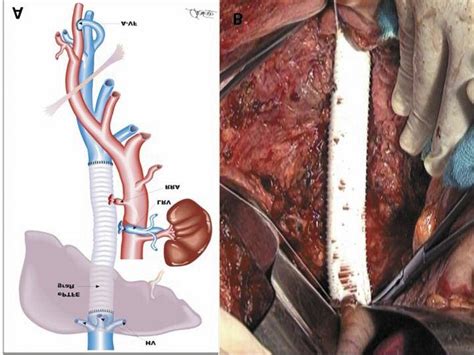 Femoral Artery Bypass Graft