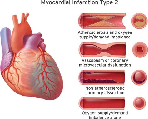 Myocardial Infarction Classification