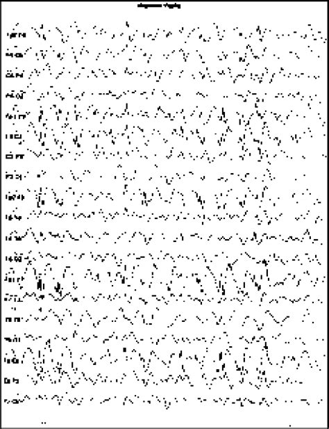 Spike And Slow Waves Complexes Download Scientific Diagram