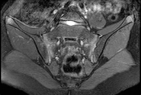 Figure From Mri Findings Of Active And Chronic Sacroiliitis In Light