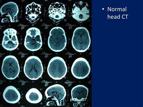 Ppt Melaporkan Hasil Ct Scan Kepala Pada Pasien Stroke Powerpoint