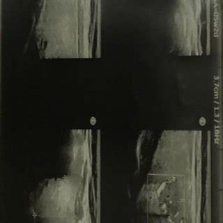 Radiografia toracică. Incidență posteroanterioară | Download Scientific Diagram