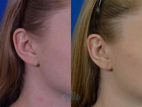 Earlobe Repair Before And After Pictures Case Charlotte Nc