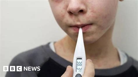 Wales Measles Cases Rise As Outbreak In South East Reaches