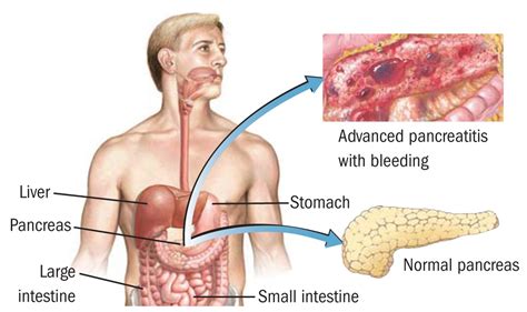 Pancreas: Symptoms Of Inflamed Pancreas