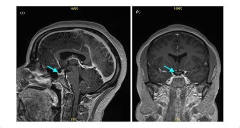 Brain Magnetic Resonance Imaging MRI With And Without Contrast