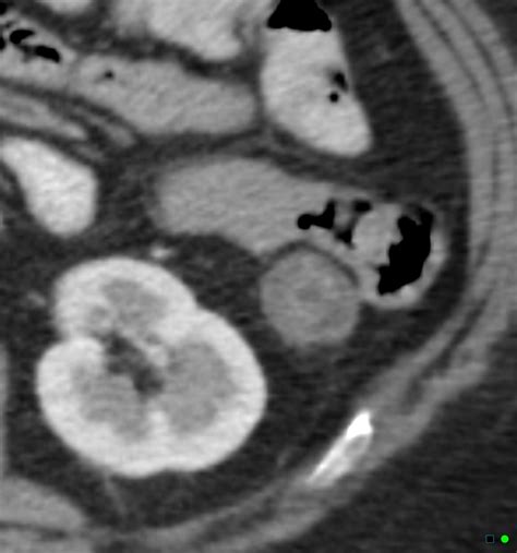 Ischemic Colitis Image Radiopaedia Org