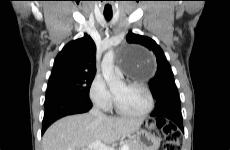 Mediastinal Teratoma Radiology Reference Article