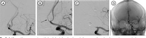 Figure 3 From Outcomes Of Stent Assisted Coil Embolization Of Wide