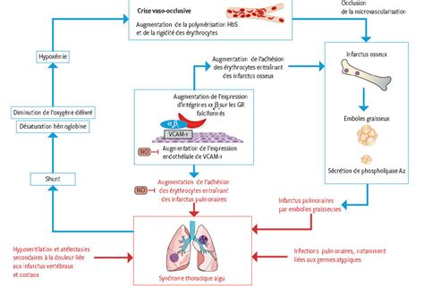 symptômes de la maladie drépanocytose