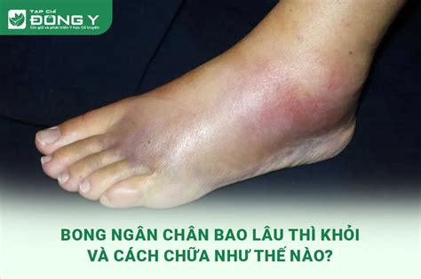 Bong Gân Chân Bao Lâu Thì Khỏi Và Cách Chữa Như Thế Nào