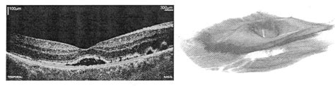 Figure 1 From High Speed Ultrahigh Resolution Retinal Imaging Using