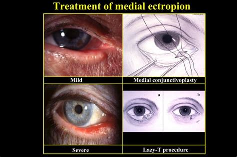 Ectropion Entropion PPT