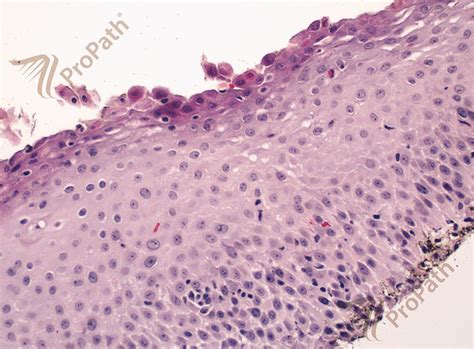 Bullous Impetigo Histology