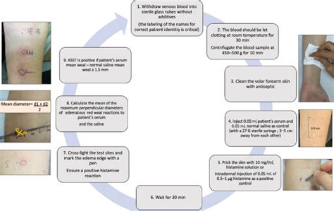 Chronic Spontaneous Urticaria The Role And Relevance Of Autoreactivity