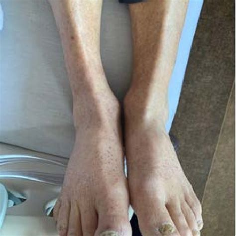 Progression Of Palpable Purpura With Coalescent Lesions In Lower Limbs Download Scientific