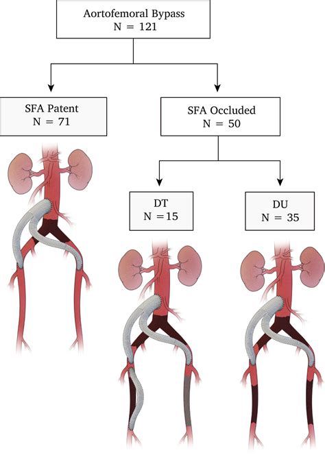 Superficial Femoral Artery Occlusion Reduces Aortofemoral Bypass Graft