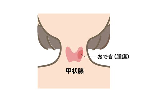 【メディケア通信】甲状腺のおでき（腫瘍）に気づいたら｜茅ヶ崎金沢内科クリニック