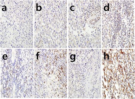 Mp The Prognostic Significance Of Tim Expressing Tumor