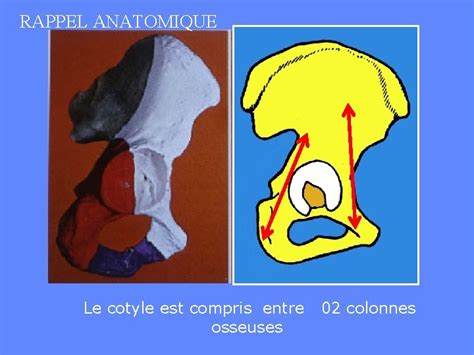 Fractures Du Cotyle Ou Fractures De Lactabulum Professeur