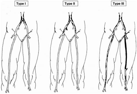 Aortoiliac Occlusive Disease – North Texas Vascular Center