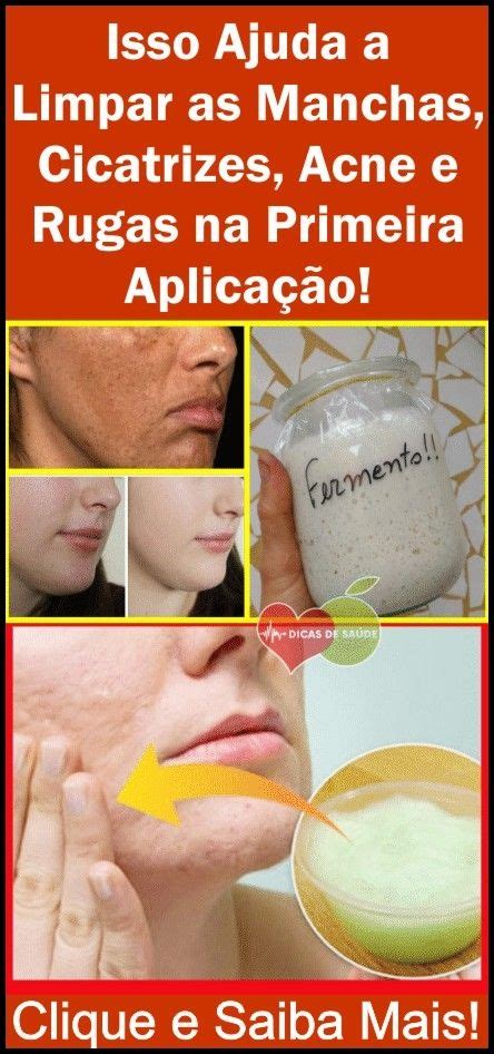 Creme Caseiro Para Remover Manchas Acne E Rugas Acne Dicas De