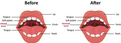 What To Expect After Your Tonsillectomy | BergerHenry ENT