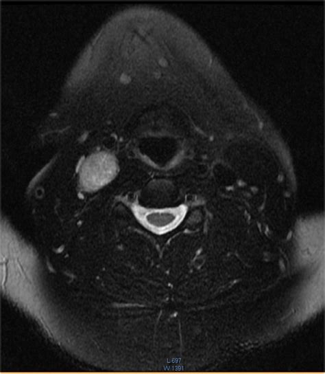 An Axial T2 Weighted Fat Saturated Mri With Post Gadolinium Contrast