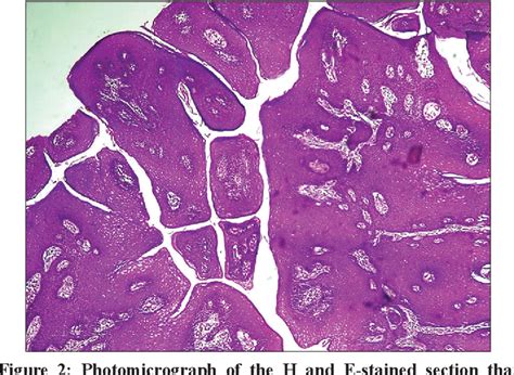 Figure 2 From Florid Vulvar Warts In A 39 Year Old Human Immunodeficiency Virus Positive Woman