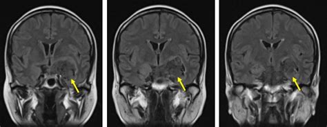 Intracranial Epidermoid Cyst Radiology Cases