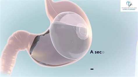 Elipse Intragastric Balloon Animation Video YouTube