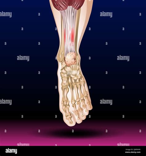 Muscle Diagram Leg Hi Res Stock Photography And Images Alamy