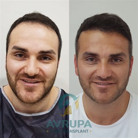 FUE Hair Transplant Results : 10 Real Cases With Photos - Clinic Advisor