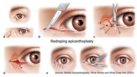 Medial Epicanthoplasty Key Technique For Patients With Monolid