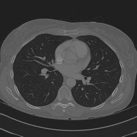 Sternal Fracture Radiology Case Radiopaedia Org