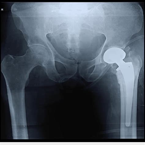 Postoperative X Ray Of The Same Patient After Cemented Bipolar Download Scientific Diagram