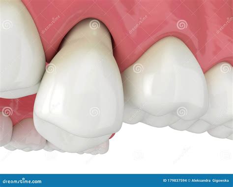 D Render Of Jaw With Protruding Tooth Revealing Root Royalty Free