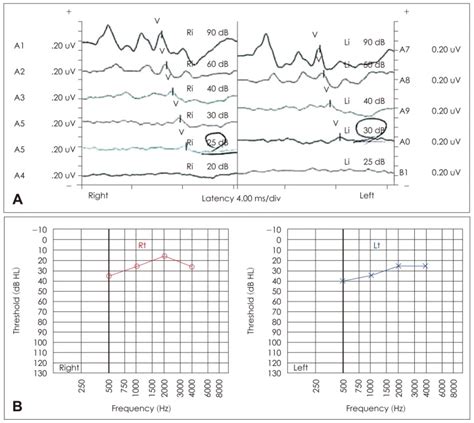 Acoustic Brainstem Response Threshold Abrt And Auditory Steady State Download Scientific