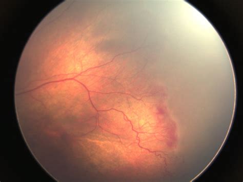 Retinopathy Of Prematurity