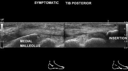 Posterior Tibial Tendon Dysfunction Posterior Tibial Tendinitis Porn