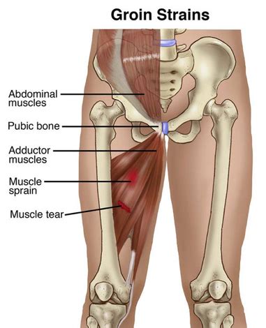 Heres A Quick Way To Solve A Info About How To Cure Groin Strain