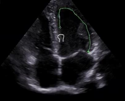 Lecture 5 Left Ventricular Ejection Fraction OpenAnesthesia