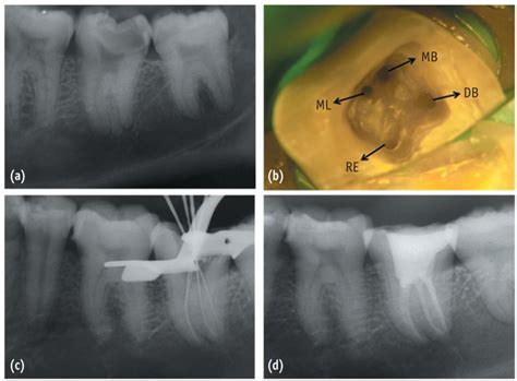 A Preoperative Radiograph Of B Access Opening Showing The