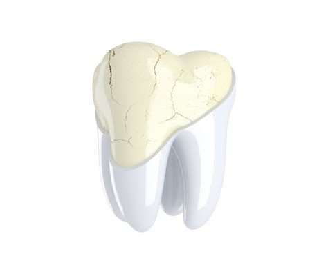 What Is Cracked Tooth Corbet Locke Dds Woodway Dentist