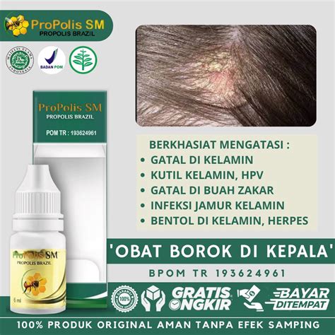 Jual Obat Tetes Borok Di Kepala Psoriasis Kepala Ketombe Berkerak