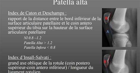 Ma bibliothèque en Imagerie Médicale PATELLA ALTA